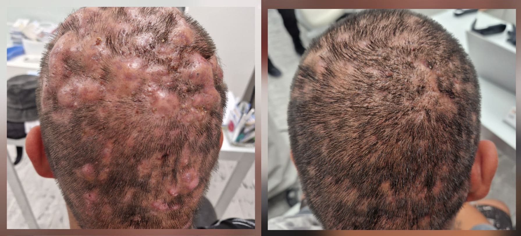 Androgenna Alopecia Lechenie