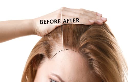 Hair loss treatment
