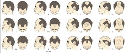 Types of hair loss