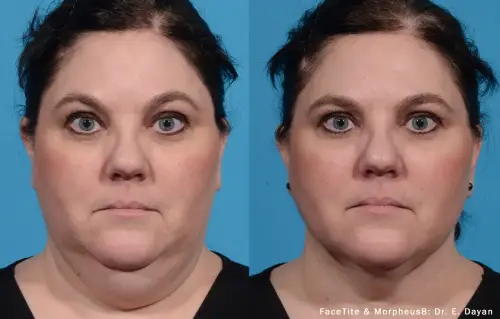 Result of the Morpheus8 procedure