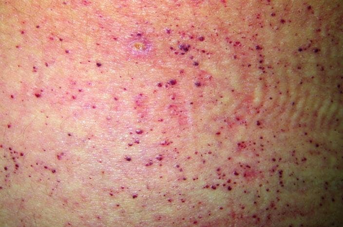 Angiokeratoma skin lesions of different types