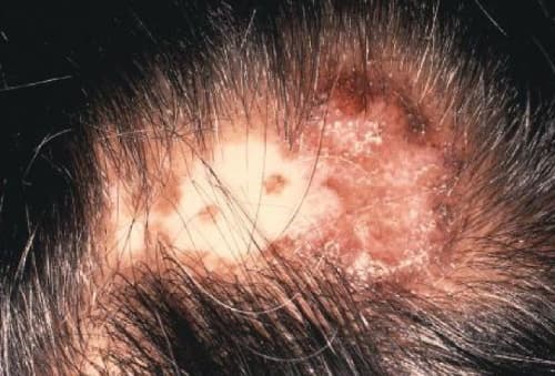 Discoid lupus erythematosus on the scalp