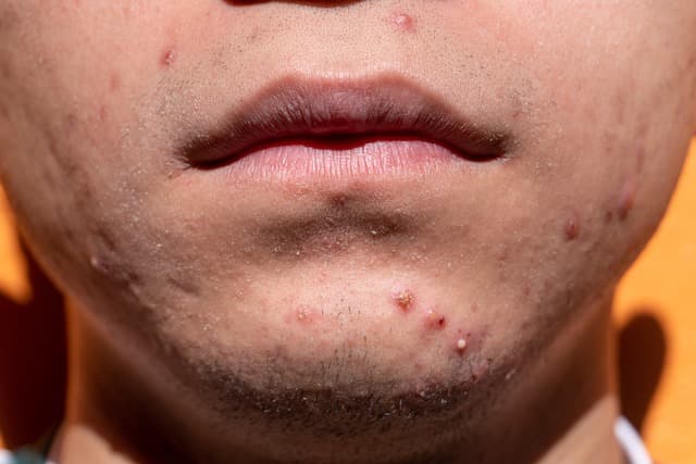 Treatments for enlarged facial pores