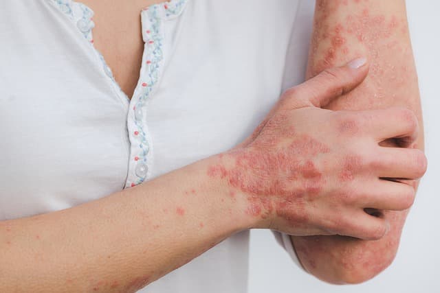 Psoriasis (scaly lichen) plaques on the skin