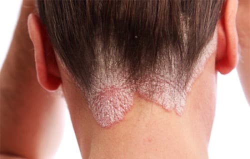 Scalp psoriasis
