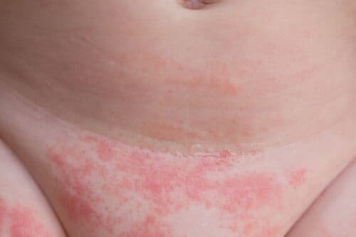 Reasons for diaper dermatitis in babies