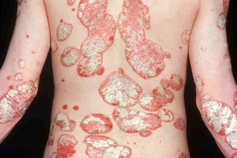 Childhood psoriasis on the skin