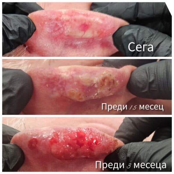 Дерматохирургия и базоцелуларен карцином