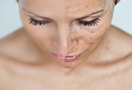 Hyperpigmentation – dark spots on the skin