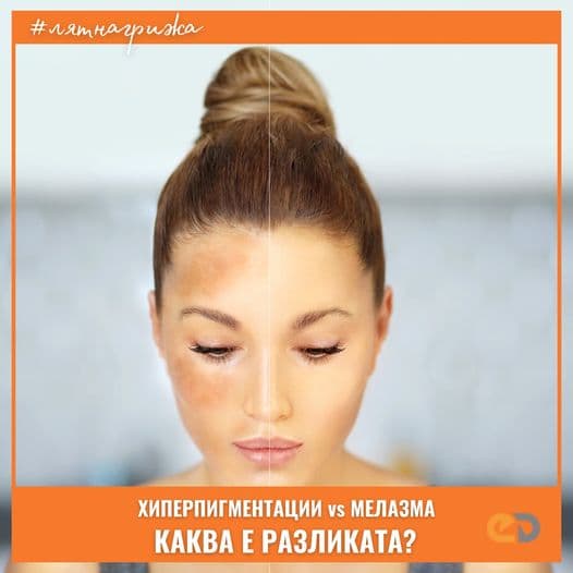 Difference between hyperpigmentation and melasma on the skin