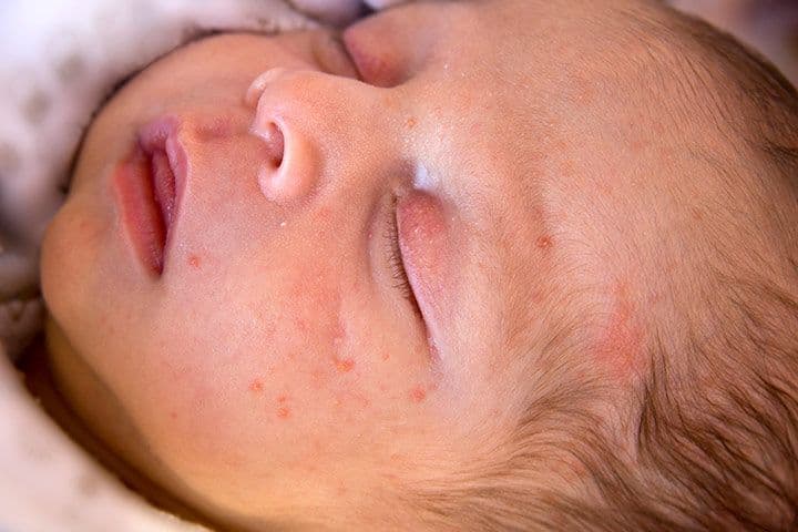 Baby acne on a newborn's skin