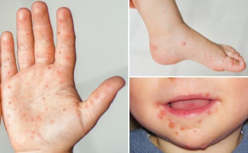 Hand, foot and mouth disease – a viral infection in children