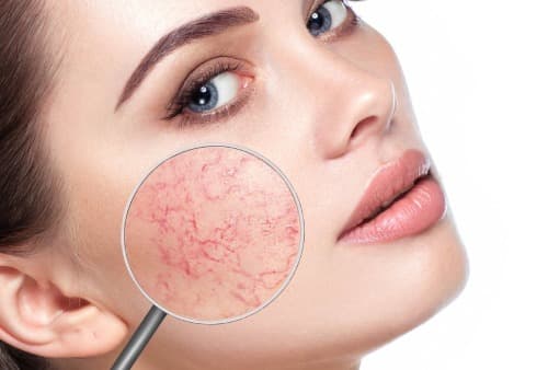 Rosacea – redness on the facial skin