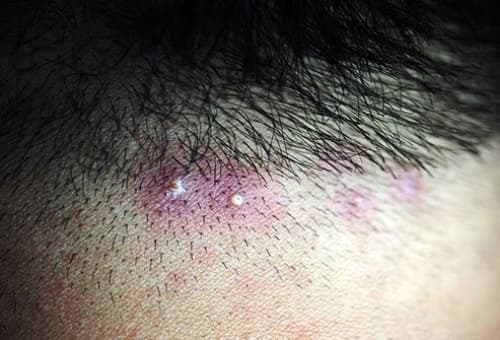 Folliculitis – inflammation of the hair follicles on the scalp