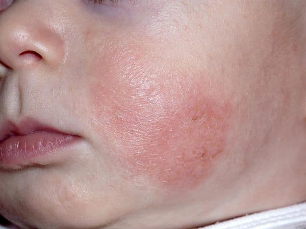 Atopic dermatitis – red and inflamed skin