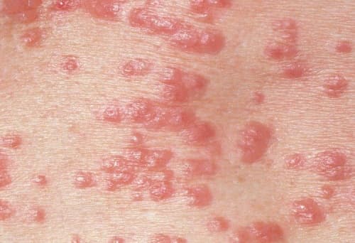 Mycosis – a fungal infection of the skin