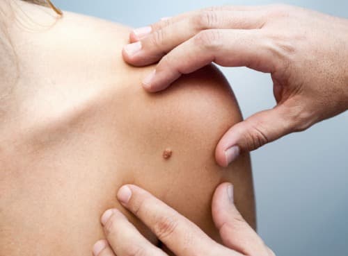 Surgical removal of skin growths
