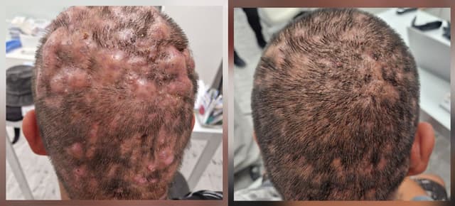 Дисекиращ целулит на скалпа – рядко възпалително заболяване, водещо до косопад и белези