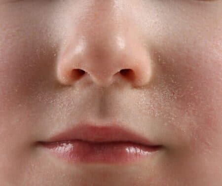 Seborrheic dermatitis on the skin