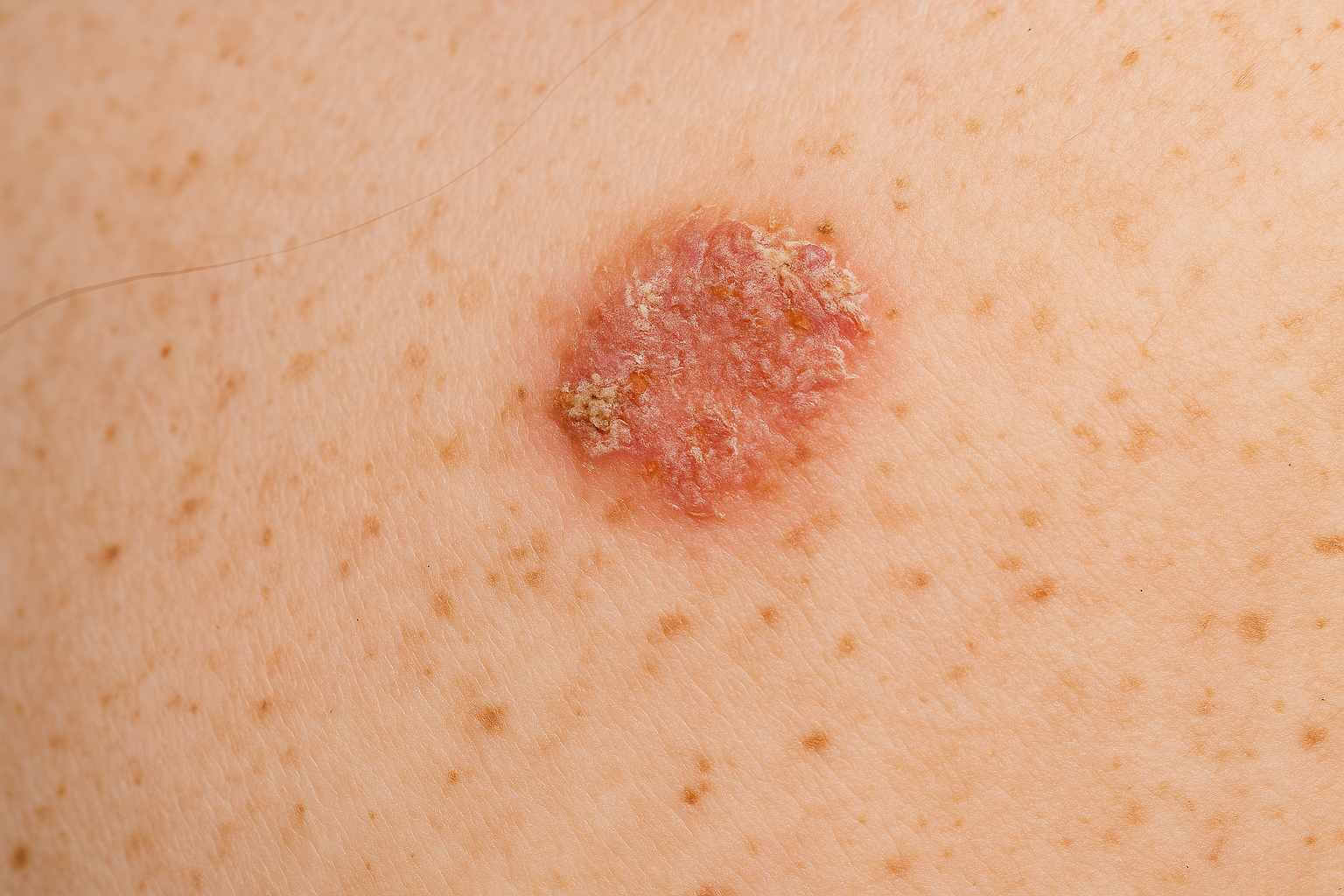 Actinic keratosis lesion before dermatological treatment