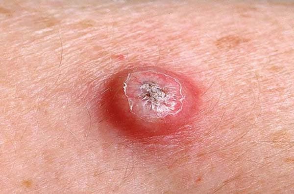 What a keratoacanthoma skin growth is