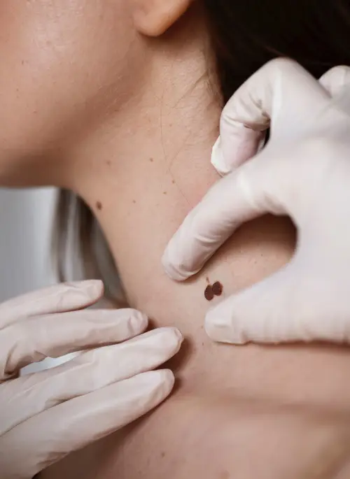 Dermatosurgery at AestheDerm clinic