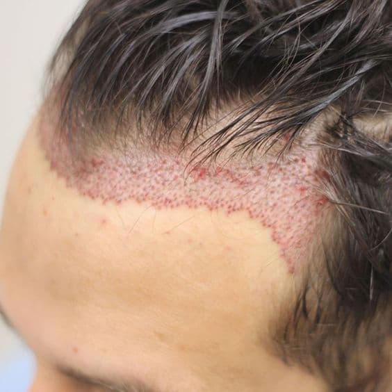 Hair transplant procedure — what to know