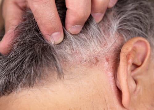 Psoriasis – a chronic inflammatory skin disease