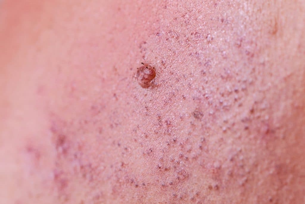 Folliculitis (inflamed hair follicles) — diagnosis and treatment