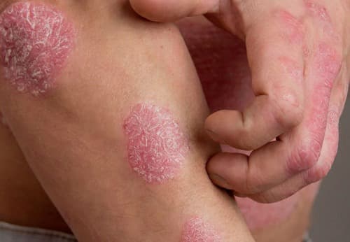 Symptoms of psoriasis on the skin