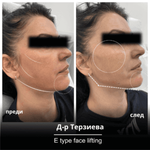 When E-Type facial lifting is suitable