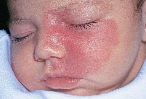 Skin tumors and growths