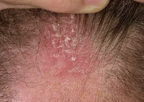 Seborrheic dermatitis and dandruff on the scalp