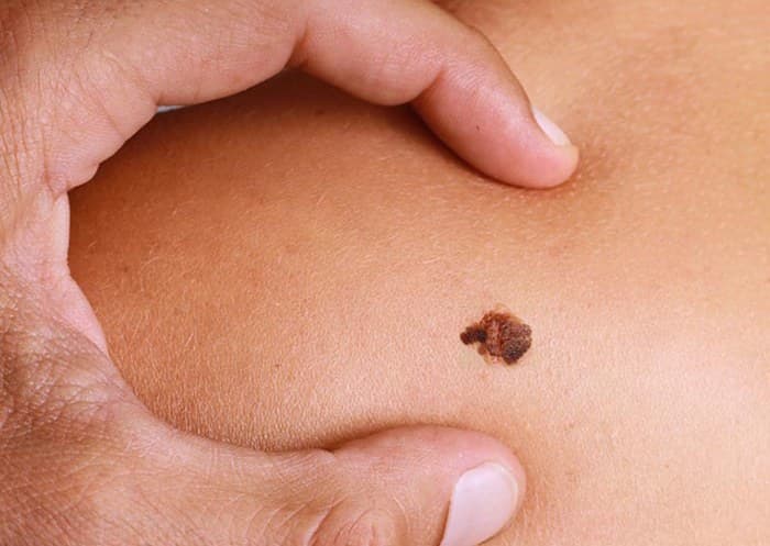 Malignant melanoma of the skin and its treatment