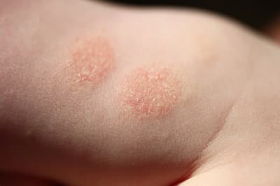 Seborrheic dermatitis in children